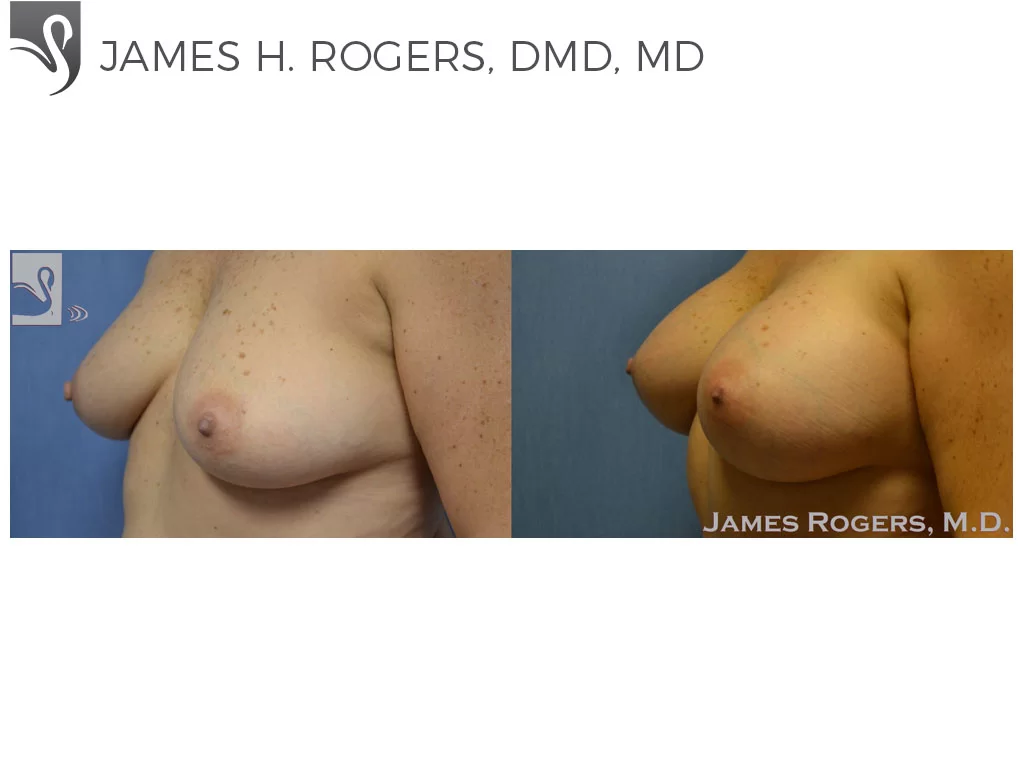 Before and After Image: Breast Augmentation Case #52304 - left-front-oblique