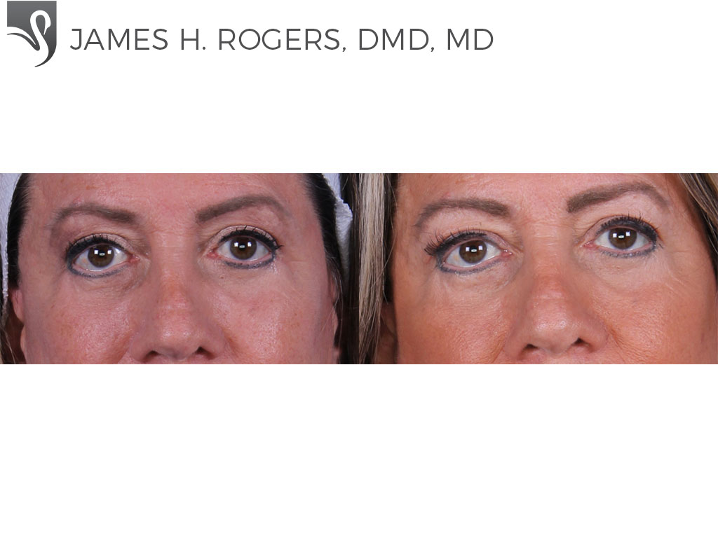 Before and After Image: Eyelid Surgery Case #52421 - front