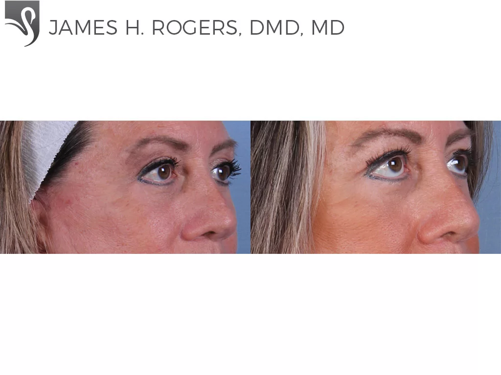Before and After Image: Eyelid Surgery Case #52421 - right-front-oblique