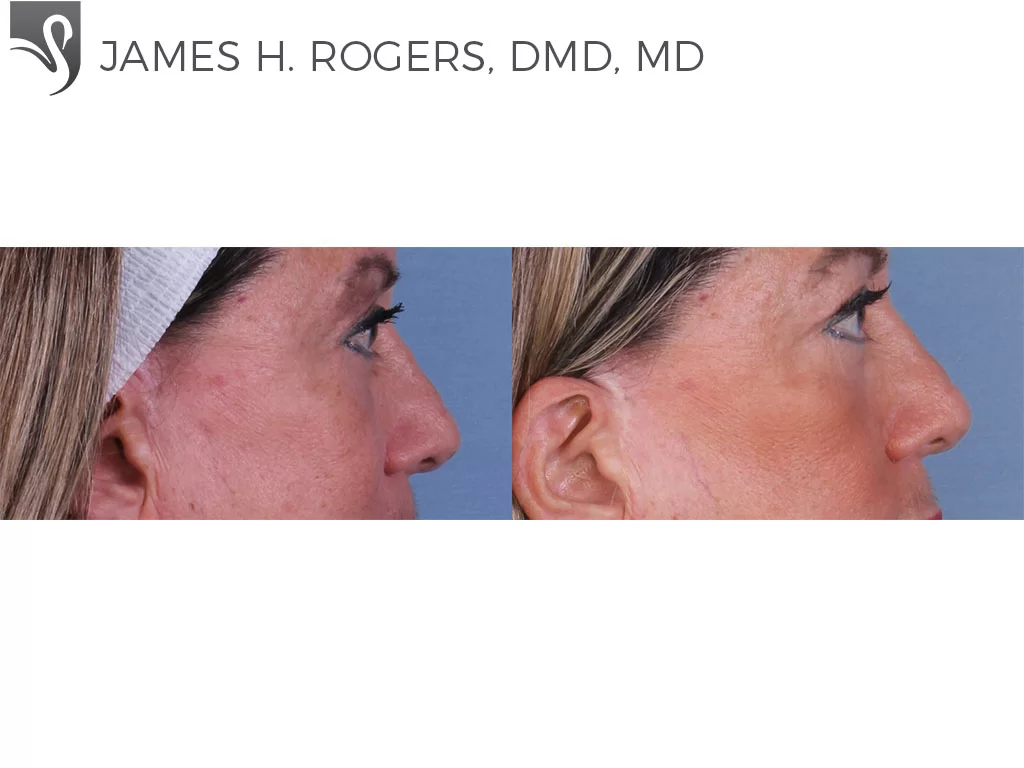 Before and After Image: Eyelid Surgery Case #52421 - right-side