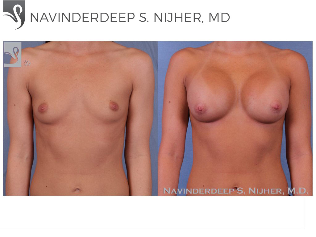 Before and After Image: Breast Augmentation Case #52509 - front