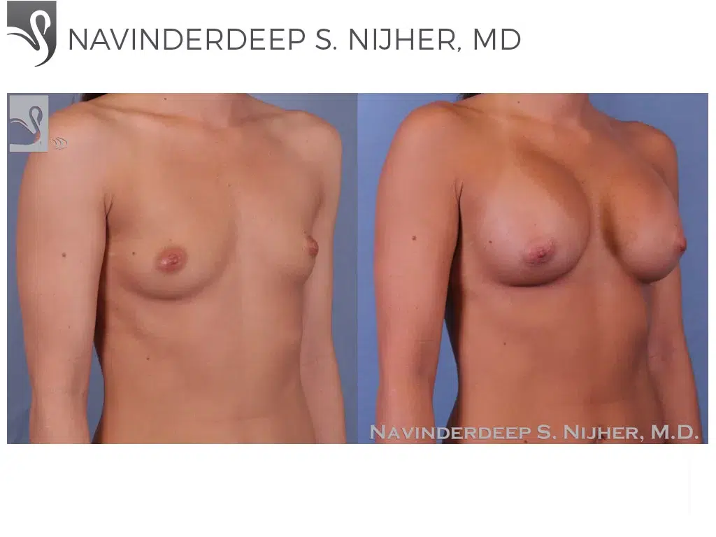 Before and After Image: Breast Augmentation Case #52509 - right-front-oblique