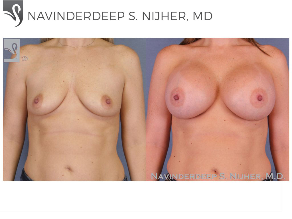 Before and After Image: Breast Augmentation Case #52586 - front