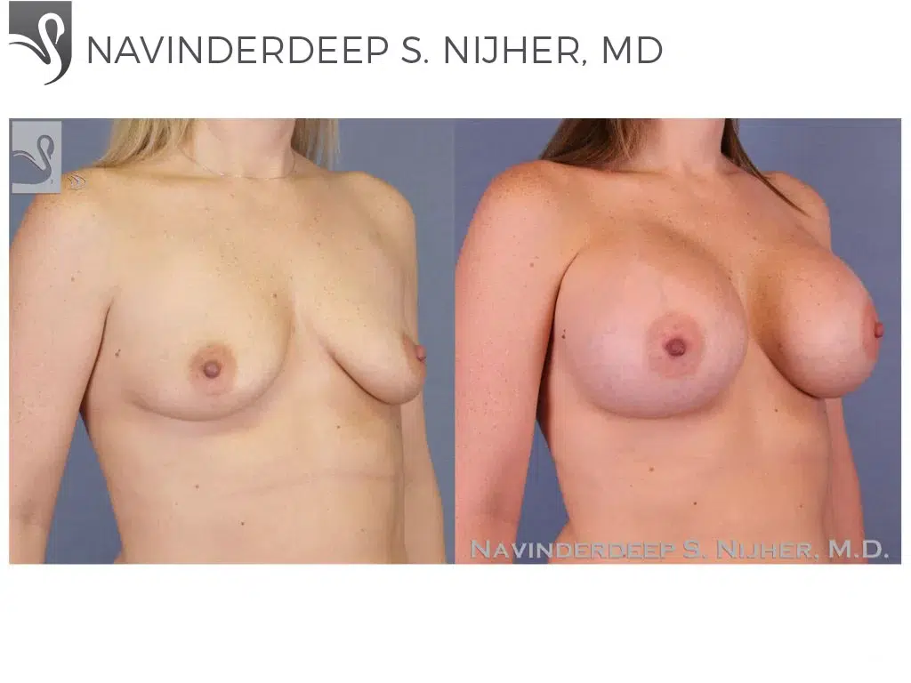 Before and After Image: Breast Augmentation Case #52586 - right-front-oblique