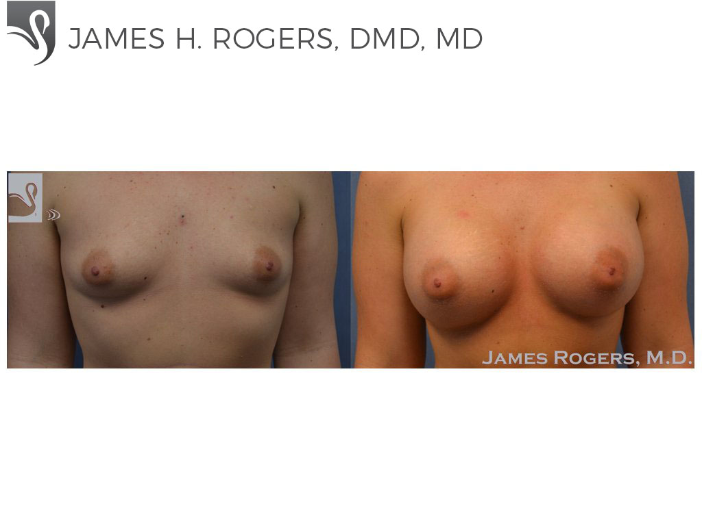 Before and After Image: Breast Augmentation Case #52613 - front