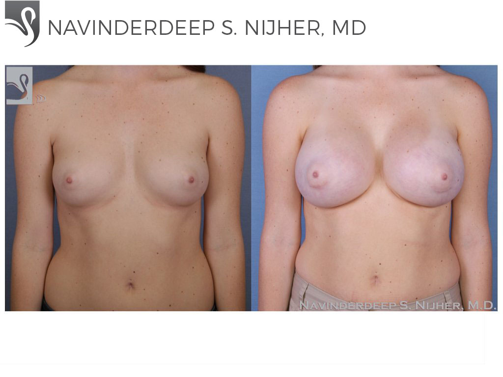 Before and After Image: Breast Augmentation Case #52728 - front