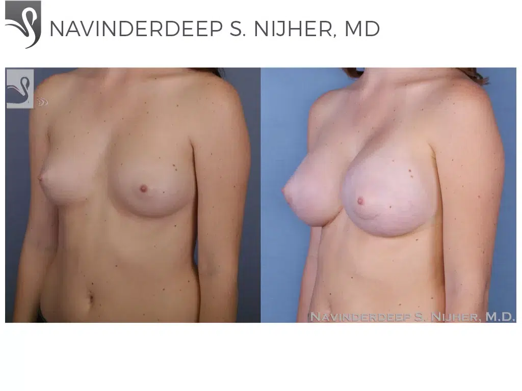 Before and After Image: Breast Augmentation Case #52728 - left-front-oblique