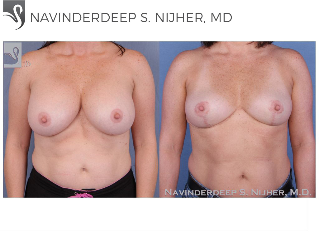 Before and After Image: Breast Revisions Case #52739 - front