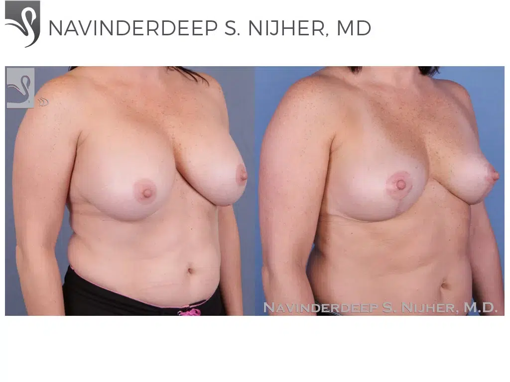 Before and After Image: Breast Revisions Case #52739 - right-front-oblique