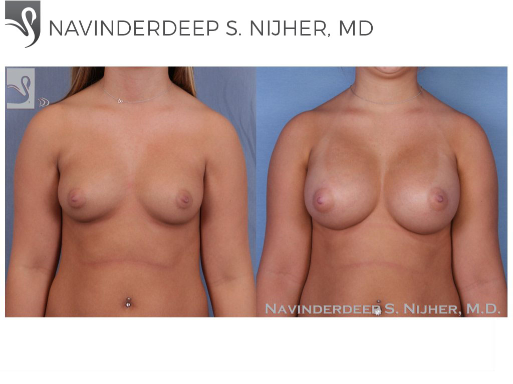 Before and After Image: Breast Augmentation Case #52753 - front