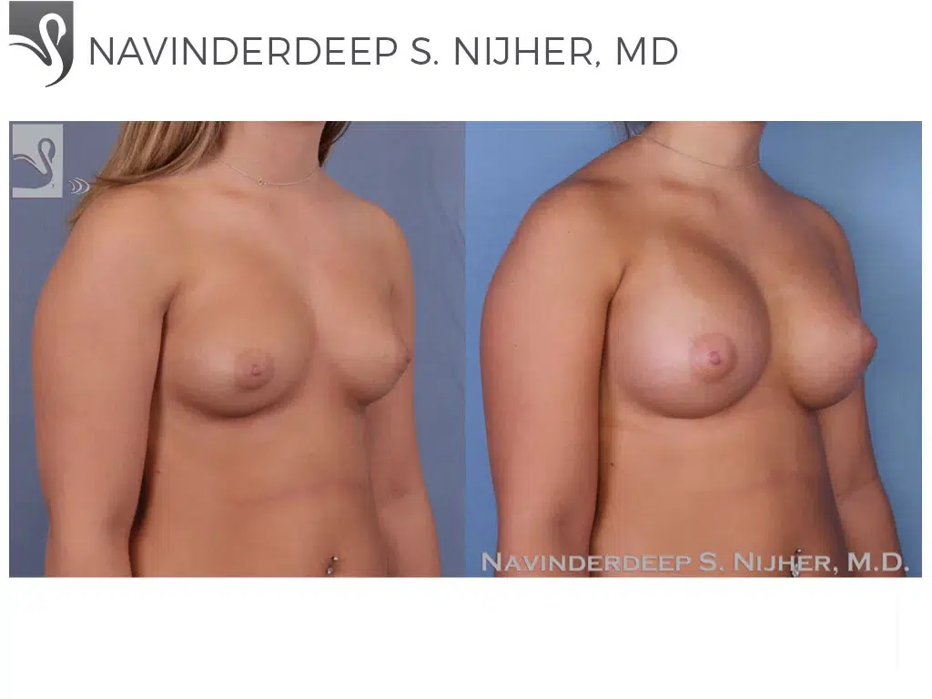 Before and After Image: Breast Augmentation Case #52753 - right-front-oblique