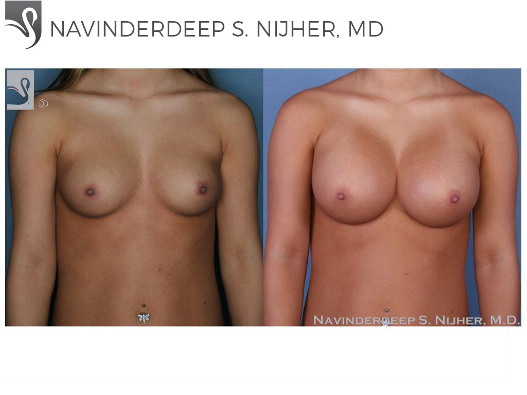 Before and After Image: Breast Augmentation Case #52755 - front