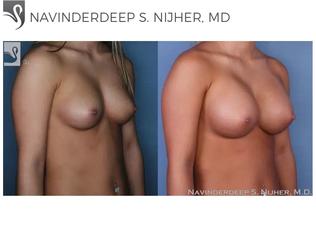 Before and After Image: Breast Augmentation Case #52755 - right-front-oblique