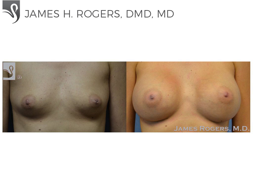 Before and After Image: Breast Augmentation Case #52769 - front