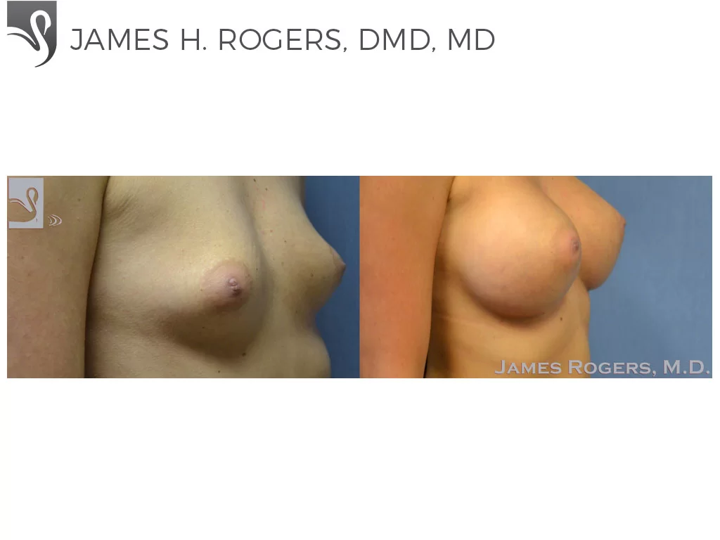 Before and After Image: Breast Augmentation Case #52769 - right-front-oblique