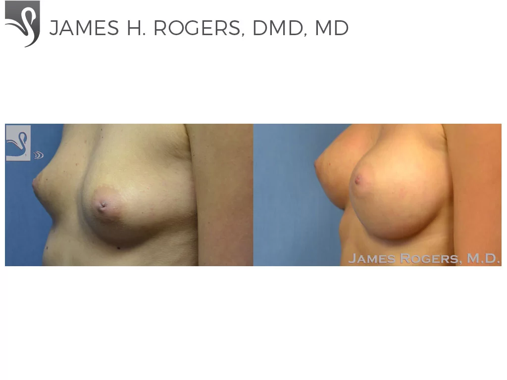 Before and After Image: Breast Augmentation Case #52769 - left-front-oblique