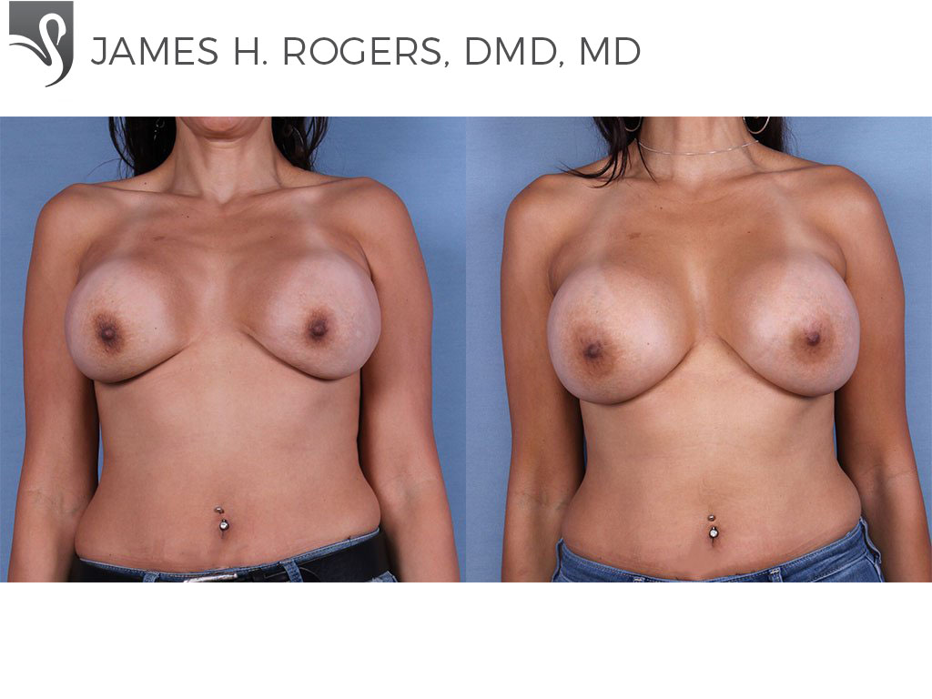 Before and After Image: Breast Revisions Case #52842 - front