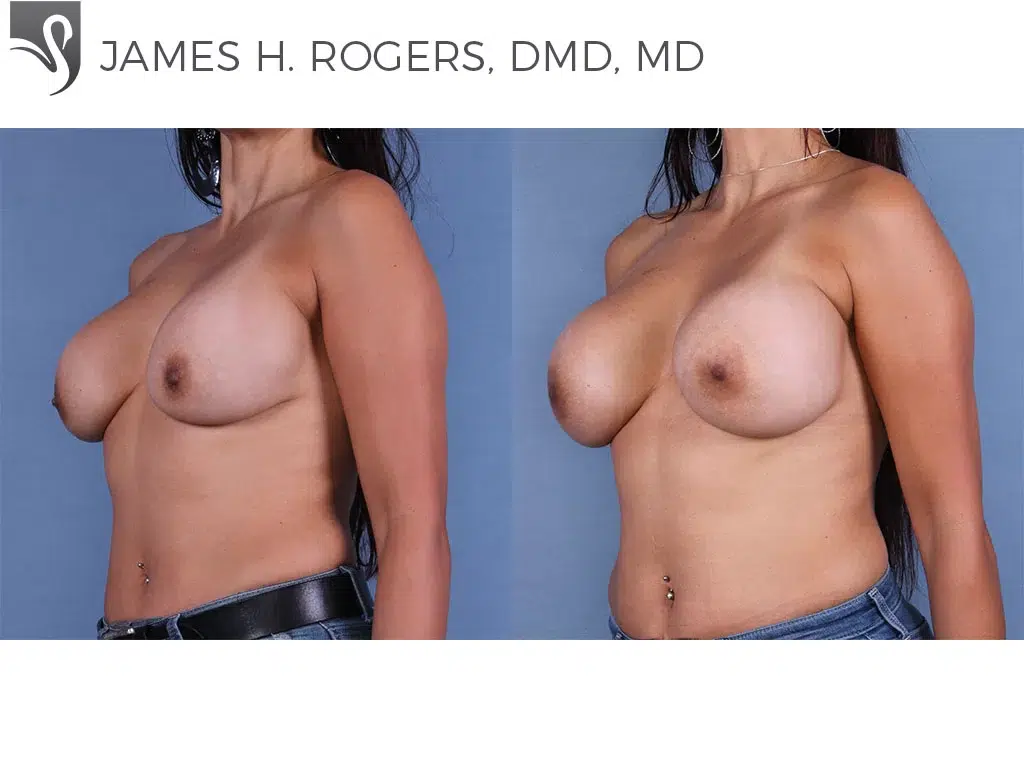 Before and After Image: Breast Revisions Case #52842 - left-front-oblique