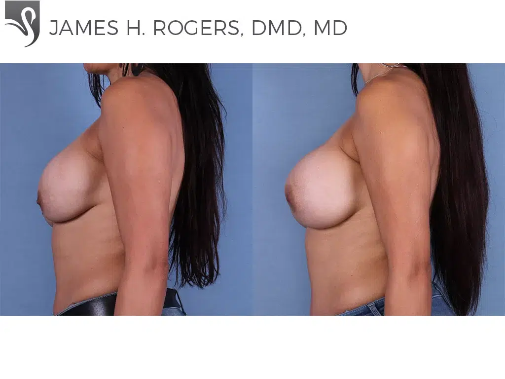 Before and After Image: Breast Revisions Case #52842 - left-side
