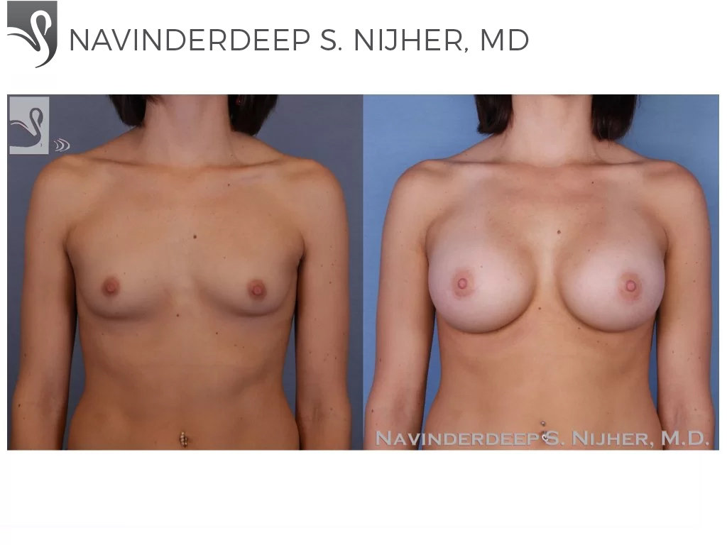 Before and After Image: Breast Augmentation Case #52959 - front