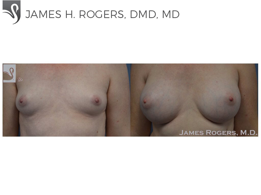 Before and After Image: Breast Augmentation Case #53088 - front