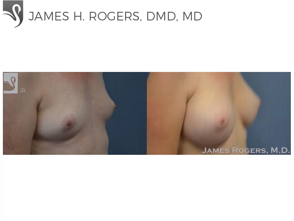 Before and After Image: Breast Augmentation Case #53088 - right-front-oblique