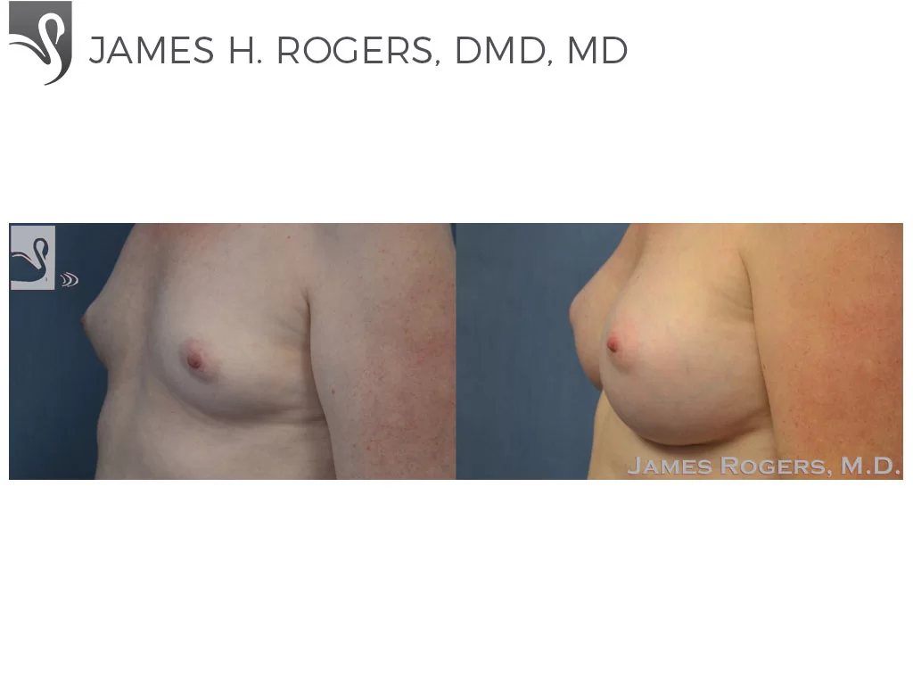 Before and After Image: Breast Augmentation Case #53088 - left-front-oblique