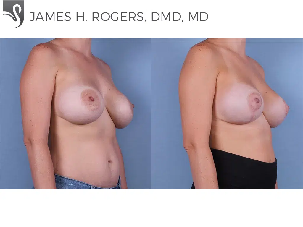 Before and After Image: Breast Lift (Mastopexy) Case #53251 - right-front-oblique