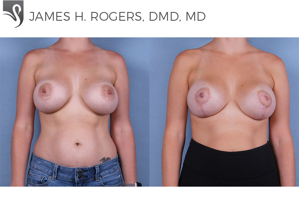 Before and After Image: Breast Lift (Mastopexy) Case #53251