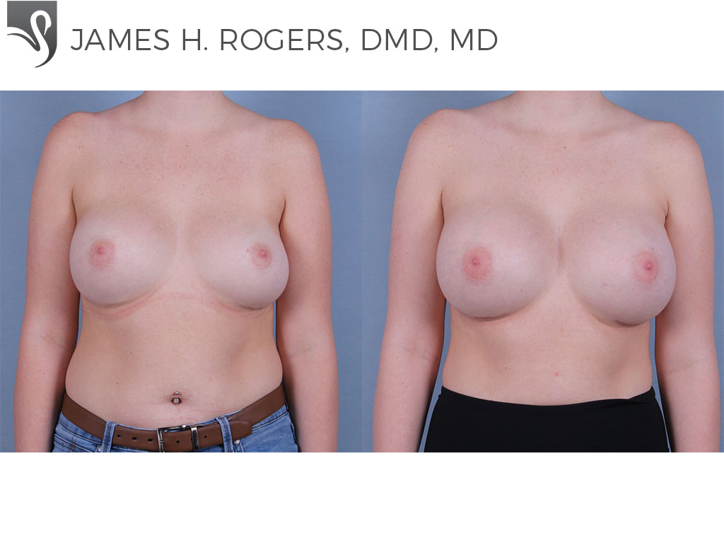 Before and After Image: Breast Revisions Case #53292 - front