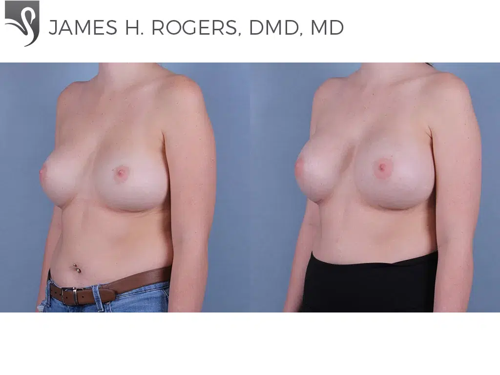 Before and After Image: Breast Revisions Case #53292 - left-front-oblique