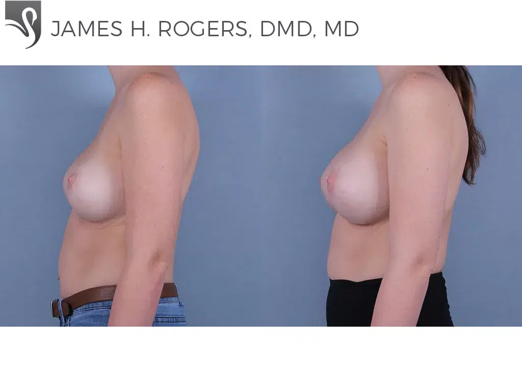 Before and After Image: Breast Revisions Case #53292 - left-side