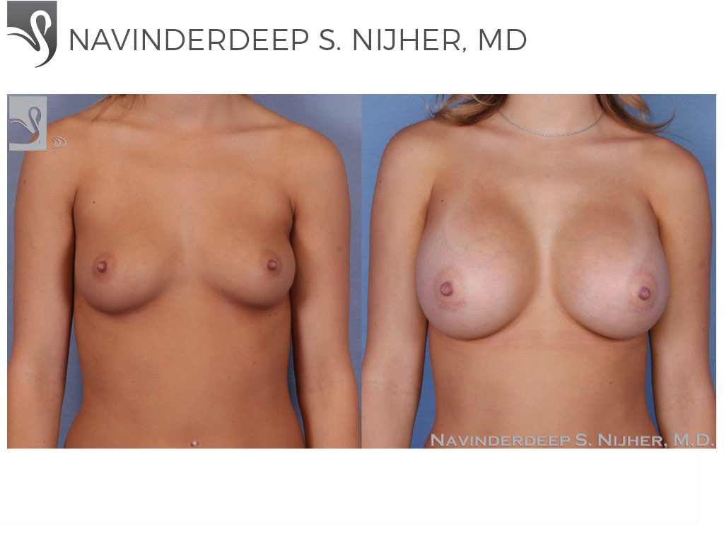 Before and After Image: Breast Augmentation Case #53297 - front