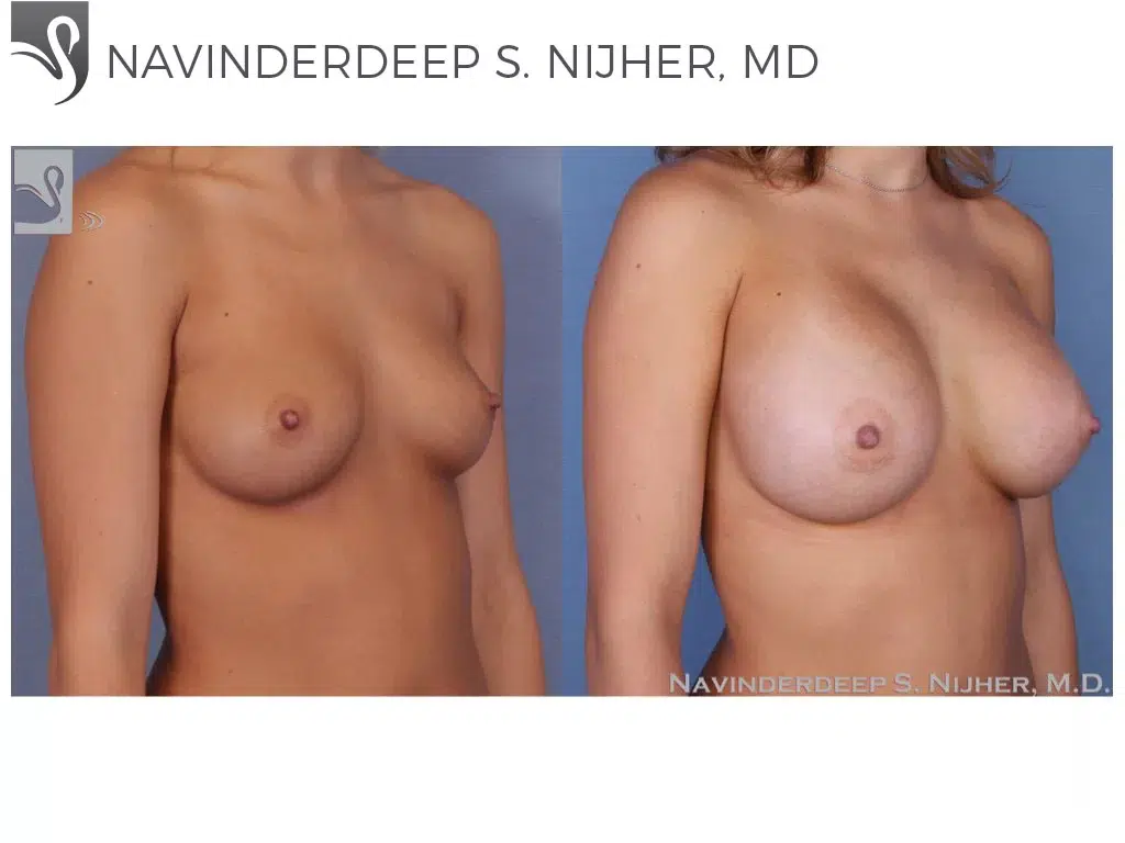 Before and After Image: Breast Augmentation Case #53297 - right-front-oblique