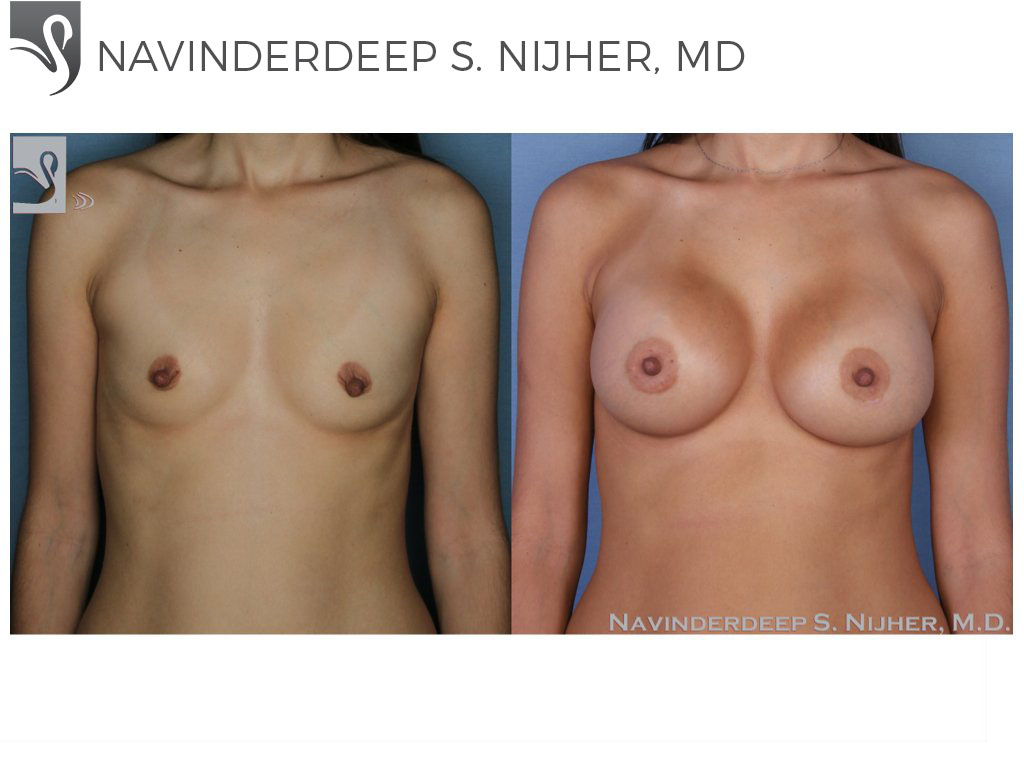 Before and After Image: Breast Augmentation Case #53313 - front