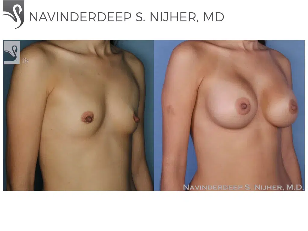 Before and After Image: Breast Augmentation Case #53313 - right-front-oblique