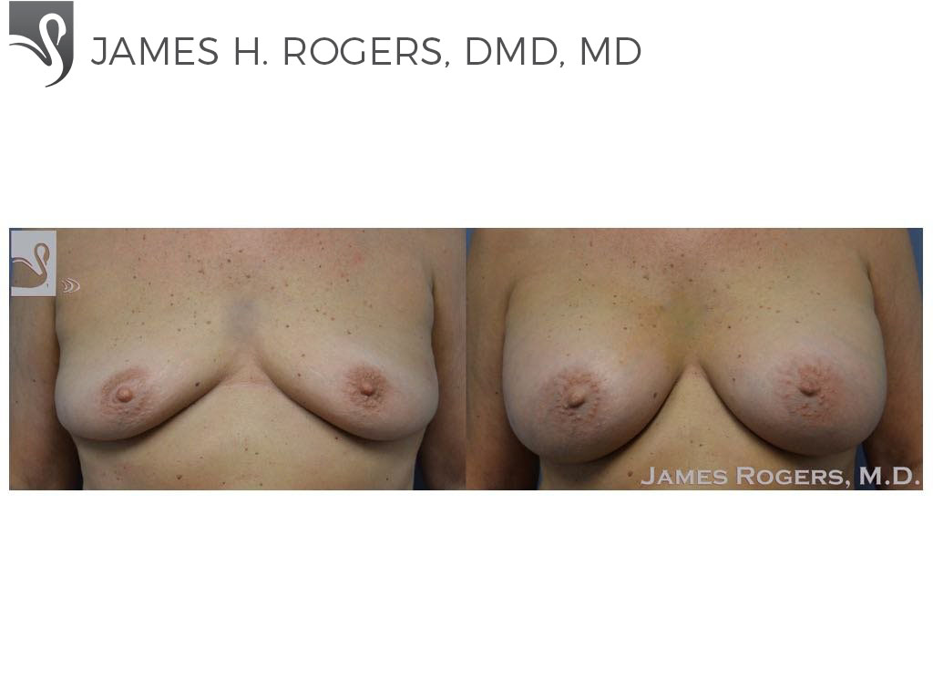 Before and After Image: Breast Augmentation Case #53314 - front