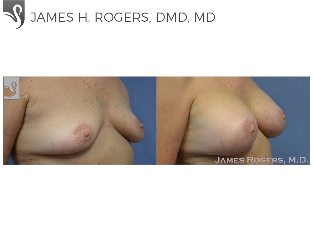 Before and After Image: Breast Augmentation Case #53314 - right-front-oblique