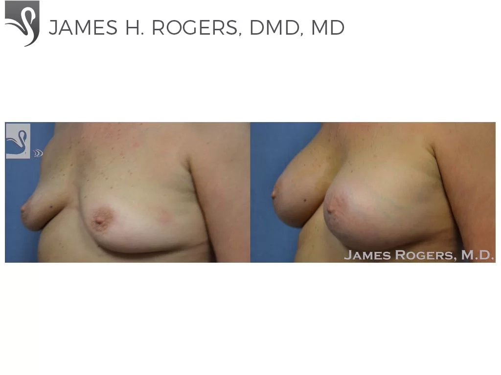 Before and After Image: Breast Augmentation Case #53314 - left-front-oblique