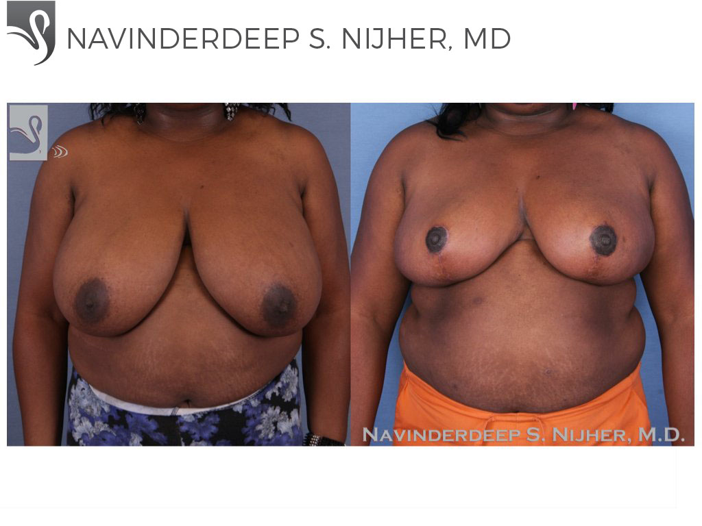 Before and After Image: Female Breast Reduction Case #53365 - front