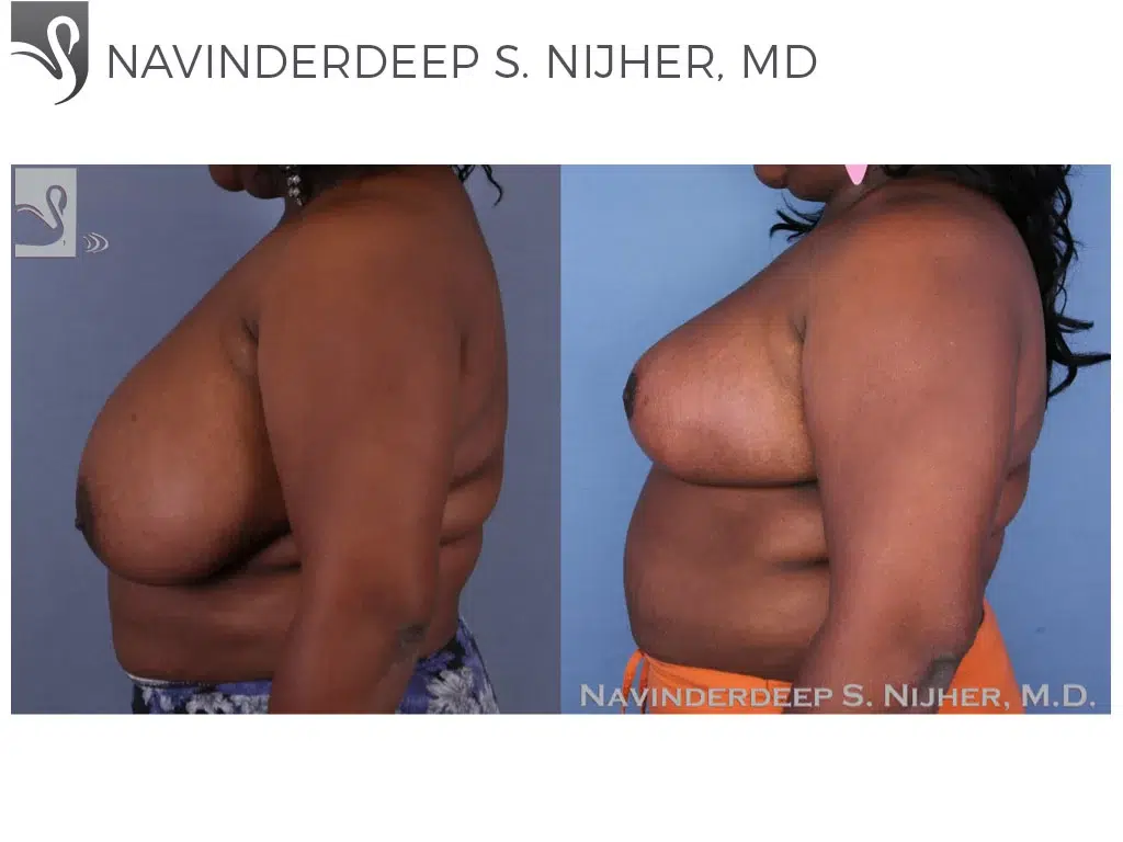 Before and After Image: Female Breast Reduction Case #53365 - left-side