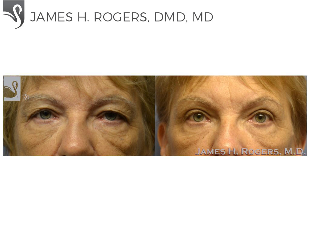Before and After Image: Eyelid Surgery Case #53613 - front