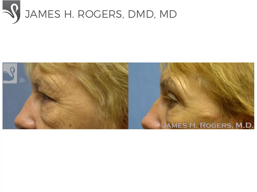 Before and After Image: Eyelid Surgery Case #53613 - left-side