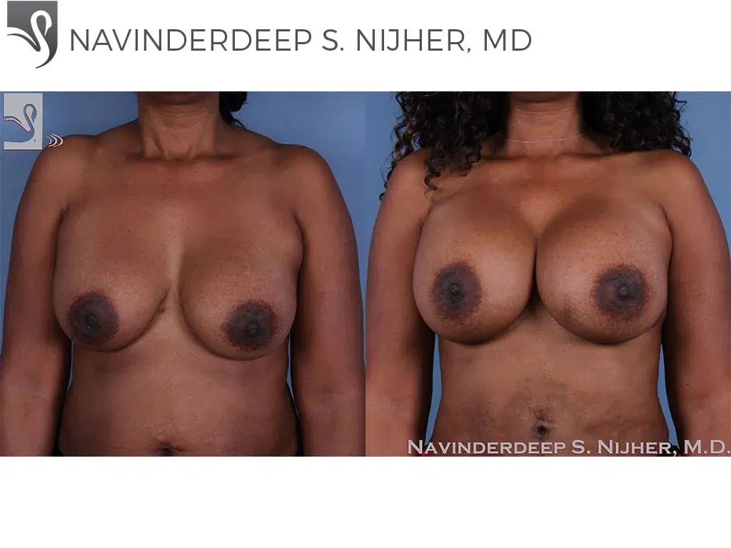 Before and After Image: Breast Revisions Case #53643 - front