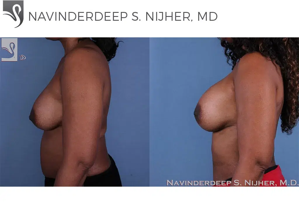 Before and After Image: Breast Revisions Case #53643 - left-side