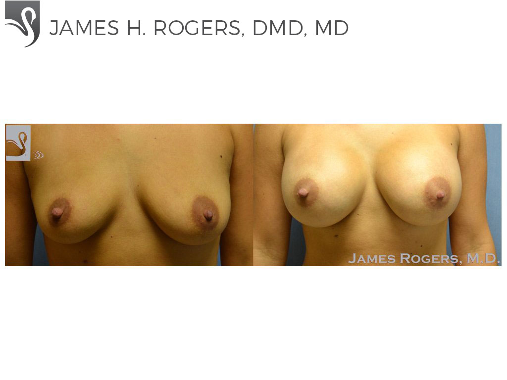 Before and After Image: Breast Augmentation Case #53657 - front