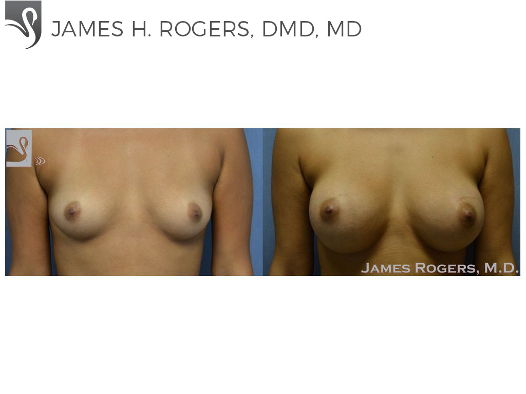 Before and After Image: Breast Augmentation Case #53744 - front