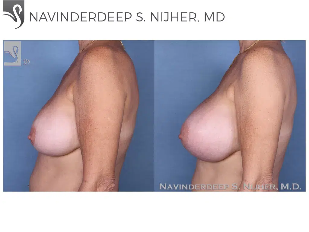 Before and After Image: Breast Revisions Case #53841 - left-side