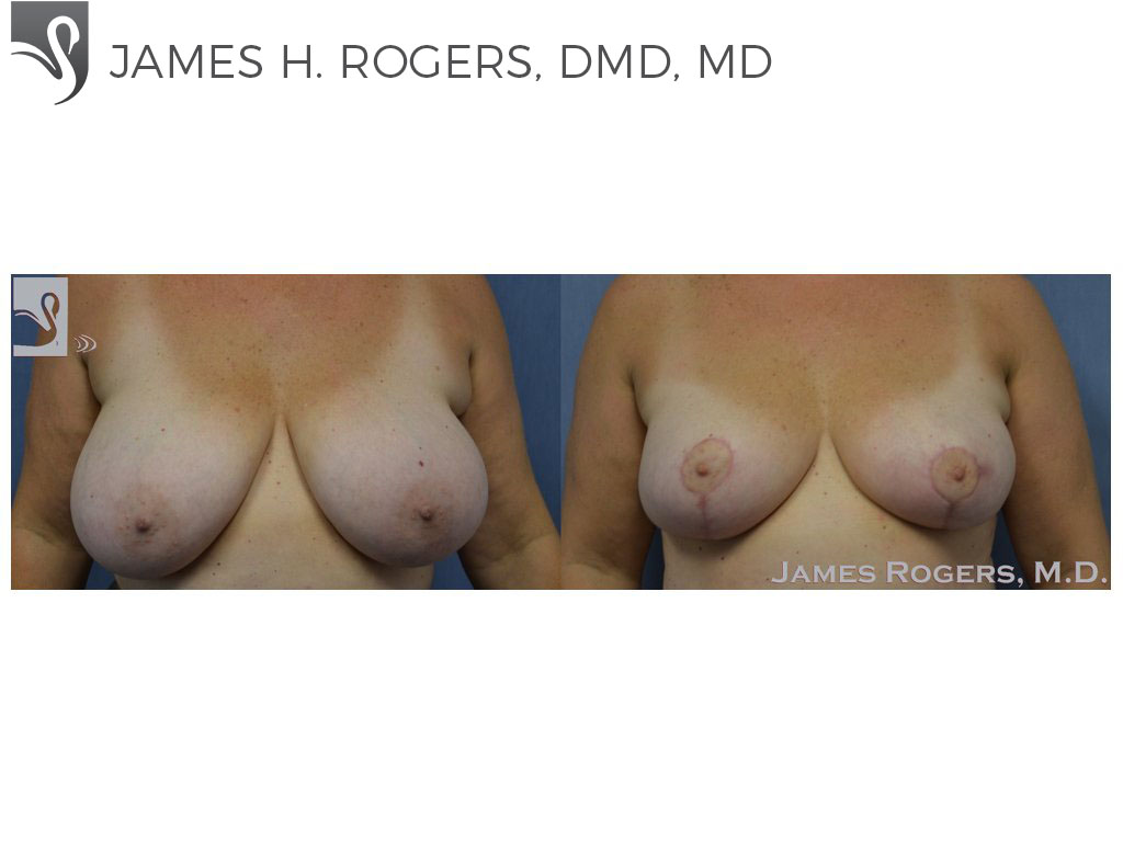 Before and After Image: Female Breast Reduction Case #53843 - front