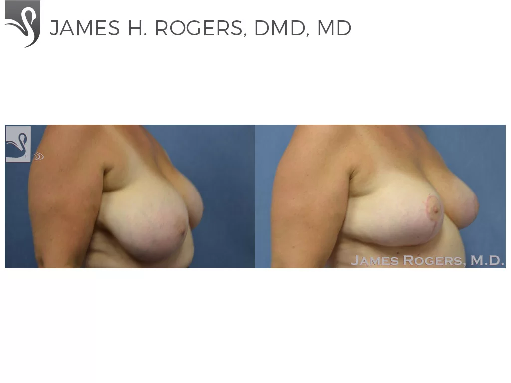 Before and After Image: Female Breast Reduction Case #53843 - right-front-oblique
